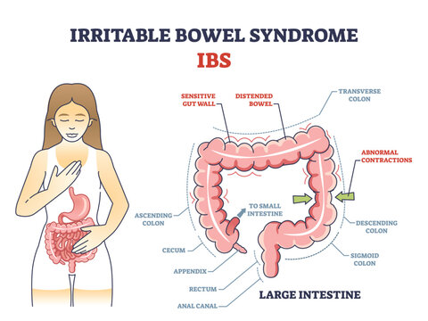 Irritable bowel syndrome or IBS as digestive health problem outline diagram. Labeled educational scheme with body gastric tract disease and stomach organ illness vector illustration. Intestine anatomy