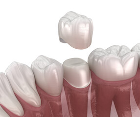 Dental crown premolar tooth assembly process. 3D illustration with transparent background
