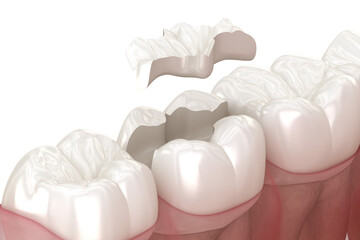 Onlay ceramic crown fixation over tooth. 3D illustration with transparent background