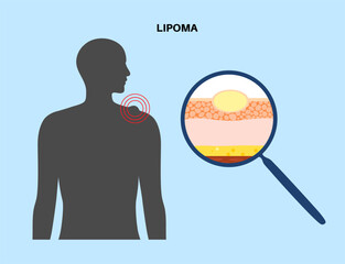 Lipoma medical poster