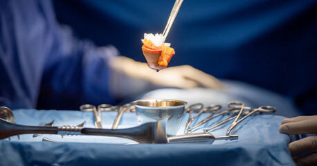 Hand of surgery doctor in Operating Room hold operating plier forceps tweezer pinch gauze and Dip...