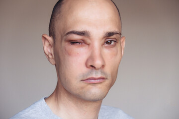 Caucasian man has angioedema around the eyes caused by allergic reaction to agents such as insect bites, foods, or medications. Swollen face.