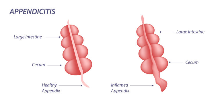 Appendicitis is an inflammation of the appendix. Appendicitis inflammation pain vector illustration. Abdominal lower belly pain 