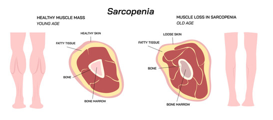 Loss of muscle mass and strength Sarcopenia vector illustration. Difference between Young age muscle mass and Old age muscle mass.  - obrazy, fototapety, plakaty