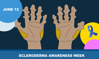 a pair of hands with a rare disease called SCLERODERMA. an autoimmune connective tissue and rheumatic disease that causes inflammation in the skin and other areas of the body. SCLERODERMA AWARENESS