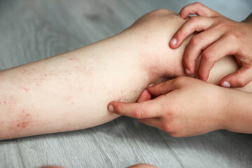 atopic dermatitis on the legs of a child