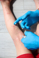 atopic dermatitis on the legs of a child