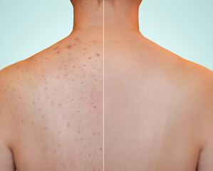 Closeup young woman's back with red rash skin and acne scar on especially on shoulder. Image...
