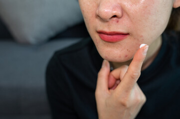 Fototapeta premium Cropped shot of woman trying to applying acne cream on her skin. Acne is a skin condition that occurs when your hair follicles become plugged with oil and dead skin cells.