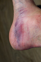 Close-up view of sprained ankle - obrazy, fototapety, plakaty