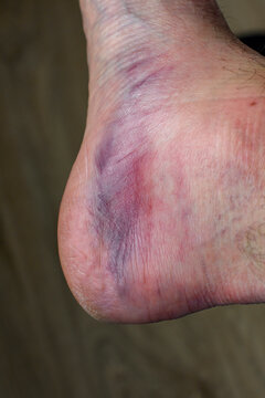 Close-up view of sprained ankle