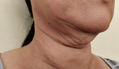 Portrait showing the flabbiness cellulite adipose hanging under the neck, problem wrinkled under the chin of the woman, concept health care. - obrazy, fototapety, plakaty