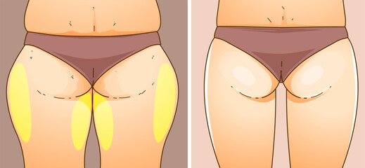 A woman's body with problem areas. Before, after. Medical infographic. Healthcare illustration. Vector illustration.
