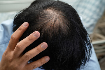 Bald in the middle head and begin no loss hair glabrous of mature Asian business smart active office man.