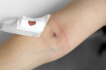 A bruise from a needle on the arm. Place a blood test from a vein on the arm. Medical sterile Plaster. Photo