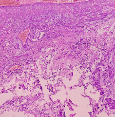 Obraz premium Soft tissue (biopsy).Glomus tumor or Paragangliomas. Microscopically show soft tissue, feature of Glomus tumor, benign but locally invasive tumors.
