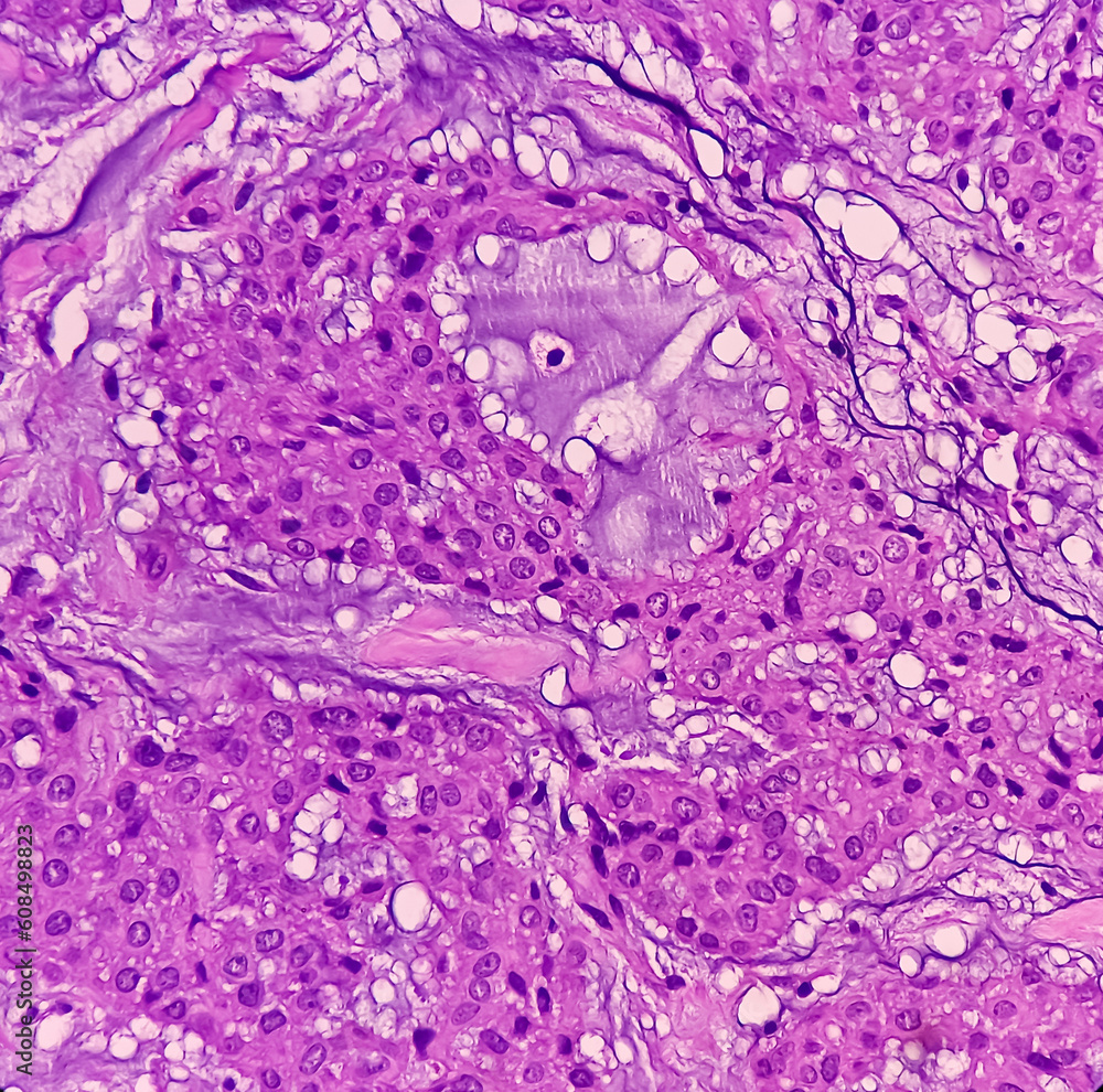 Sticker Soft tissue (biopsy).Glomus tumor or Paragangliomas. Microscopically show soft tissue, feature of Glomus tumor, benign but locally invasive tumors.