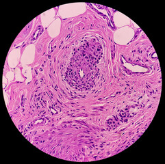 Soft tissue (biopsy).Glomus tumor or Paragangliomas. Microscopically show soft tissue, feature of...