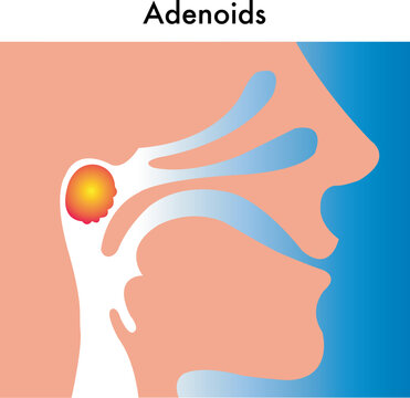 simbolic illustration of the adenoids