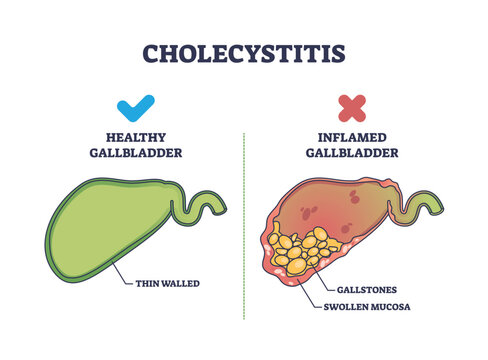Cholecystitis as inflamed gallbladder compared with healthy outline diagram. Labeled educational scheme with swollen mucosa and gallstones in digestive tract vector illustration. Stomach disease.