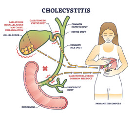 Cholecystitis as gallbladder inflammation from blocked gallbladder outline diagram. Labeled educational scheme with medical disease in digestive tract from gallstone vector illustration. Duct anatomy