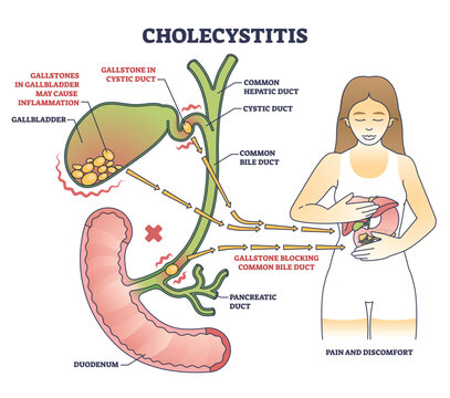 Cholecystitis as gallbladder inflammation from blocked gallbladder outline diagram. Labeled educational scheme with medical disease in digestive tract from gallstone vector illustration. Duct anatomy