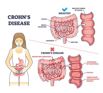 Crohns disease as inflammatory bowel problem explanation outline diagram. Labeled educational medical comparison with stomach illness and healthy colon, small intestine and gut vector illustration.