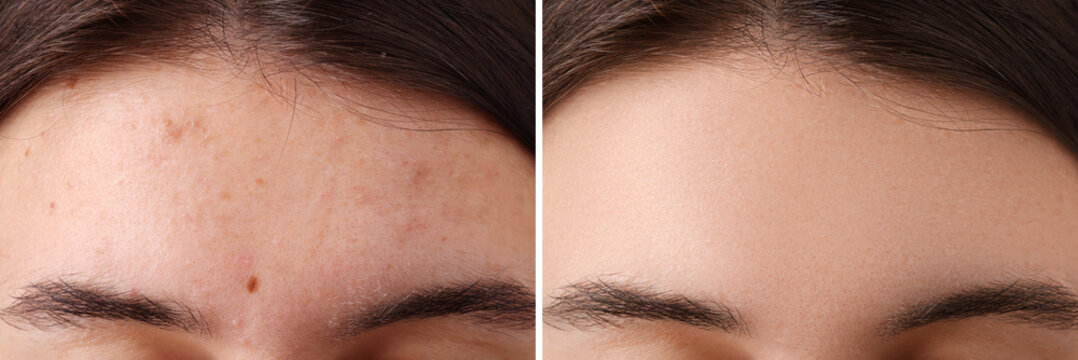Collage with photos of woman with acne problem before and after treatment, closeup. Banner design