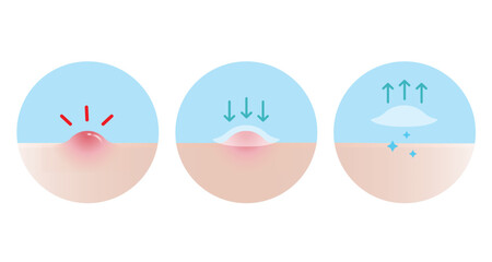 How to use acne pimple patch for inflammatory acne vector icon set illustration on white background. Step of use, direction for use acne patch absorbing papule on skin face. Skin care concept.