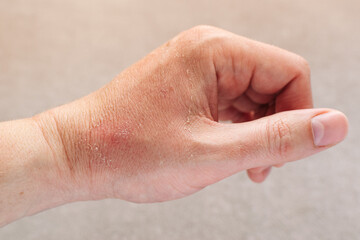Peeling of Skin after Sun or thermal Burn