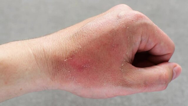 Peeling of Skin after Sun or thermal Burn