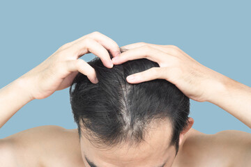 Closeup Young man serious hair loss problem with blue backgroun for health care medical and shampoo...