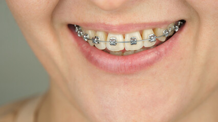 Close-up of a smile with metal braces on the teeth. Bite correction and dental health. Orthodontic treatment