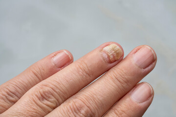 hand finger nail with fungal infection