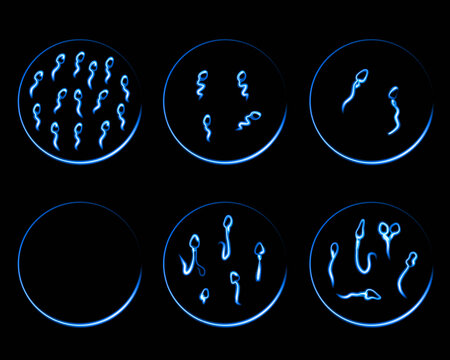 Vector isolated illustration of sperm pathologies. Spermogram. Sperm defects. Defects of the sperm head.  Sperm motility.