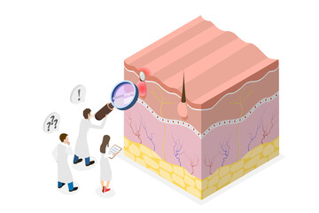 3D Isometric Flat  Conceptual Illustration of Acne Vulgari