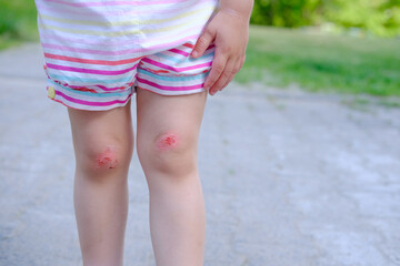 fresh wound, bleeding abrasion on knees of girl child fell on walk, traumatic safety concept for...