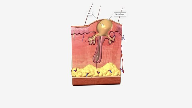 Closed comedones (whiteheads) are a type of acne characterized by small pink bumps with white, pus-filled centers.