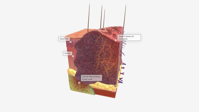 Basal Cell Carcinoma in Tissue, Stage III