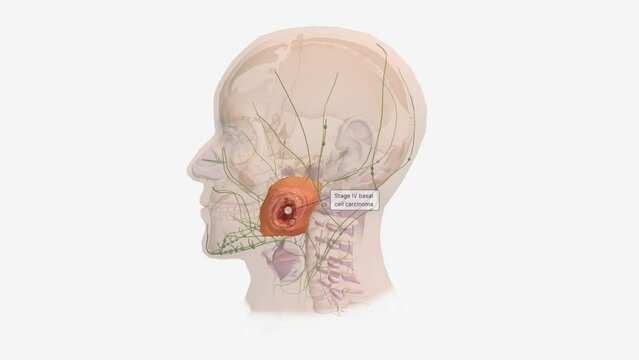 Basal Cell Carcinoma in Tissue, Stage IV