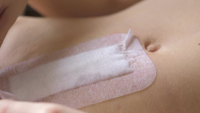 Abdomen of young girl. Closeup video of girl's hand is removing of bandage for treatment of surgical sutures after surgery for umbilical and inguinal hernias
