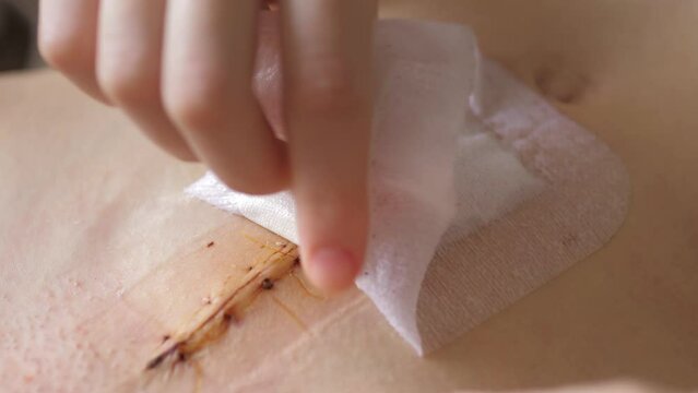 Abdomen of young girl. Closeup video of girl's hand is removing of bandage for treatment of surgical sutures after surgery for umbilical and inguinal hernias