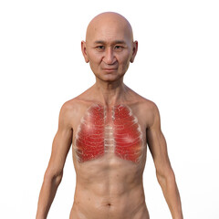 A 3D illustration showcasing the upper half part of a man with transparent skin, revealing the lungs affected by miliary tuberculosis