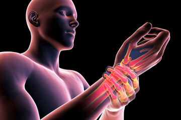 A man experiencing wrist pain, 3D illustration