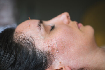 Young Caucasian woman having acupuncture sessions on her face as a beauty, anti-aging treatment. Concept of controlled aging and beauty and body care. Close-up view of the procedure. Selective focus - obrazy, fototapety, plakaty