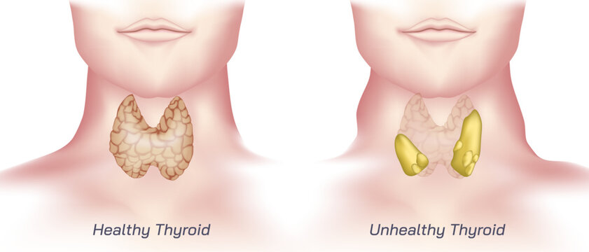 hypothyroidism vs hyperthyroidism. healthy and unhealthy thyroid test. Thyroid tumour and inflammation treatment. Parathyroid glands. neck pain and sore. Throat cancer and esophagus. Goitre problem. 