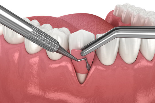 Gingiva Recession: Soft tissue graft surgery. 3D illustration of Dental  treatment