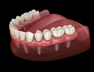 Mandibular prosthesis with gum All on 6 system supported by implants.  Medically accurate 3D illustration of human teeth and dentures concept