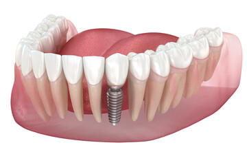 Dental implant and ceramic crown. Medically accurate tooth 3D illustration. - obrazy, fototapety, plakaty