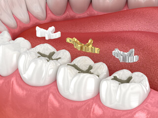 Dental fillings: ceramic, golden, metal. Dental 3D illustration